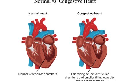 Congestive Heart Failure(CHF)