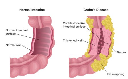 Crohn's Disease