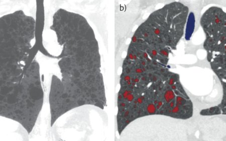 Cystic lung disease