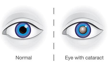 Cataracts