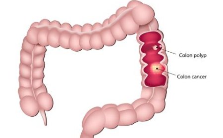 Colorectal Cancer