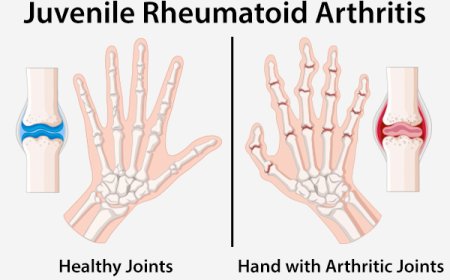 Arthritis, Juvenile Rheumatoid
