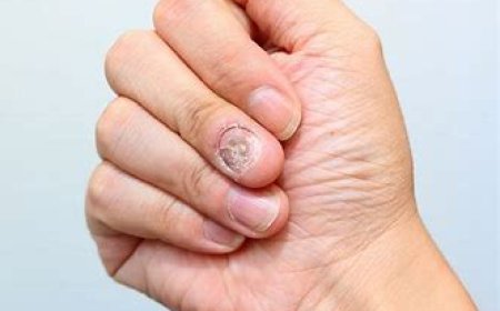 Nail Fungus