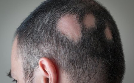 Alopecia Areta