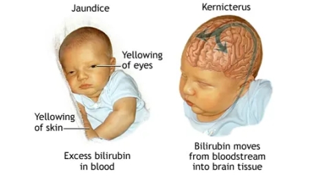 Kernicterus