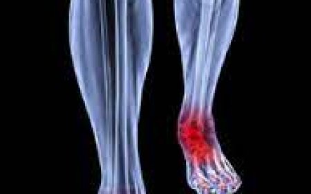 Arthritis Infectious -Septic arthritis