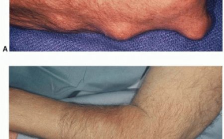 Arthritis Urethritica -Reactive arthritis