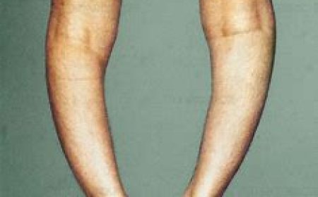 Nutrional Rickets (Vitamin D defficiency)