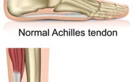 Achilles Tendon injury