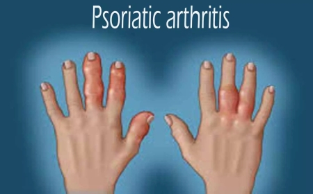 Arthritis, Psoriatic