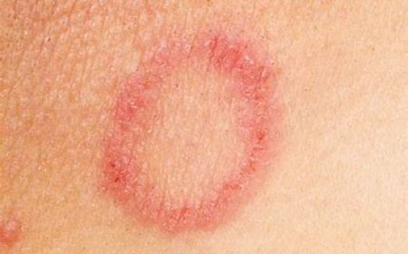 Ringworm