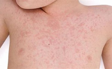 Rubella (German Measles)