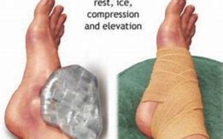 RICE method for minor injuries