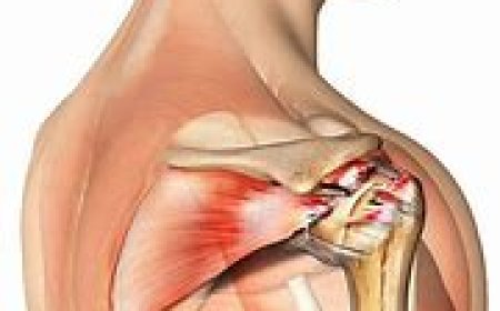 Rotator Cuff injuries