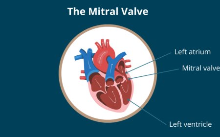 Mitral Valve Prolapse