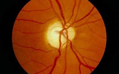 Retinal Diseases