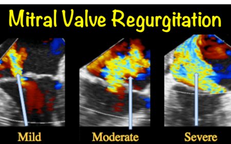 Mitral Valve Regurgitation