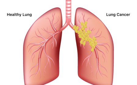 Non-small-cell Lung Cancer