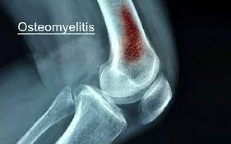 Osteomyelitis