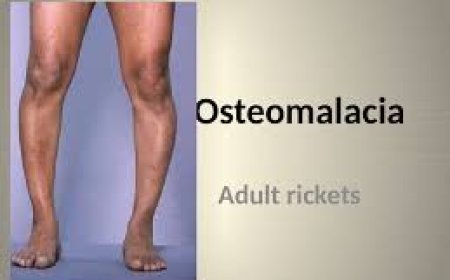 Osteomalacia