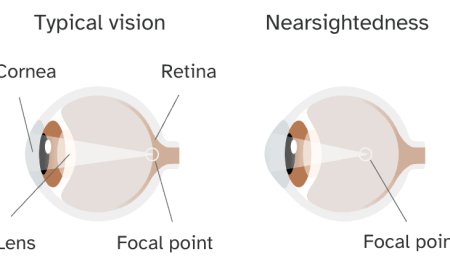 Nearsightedness