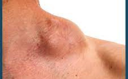 Non Hodkings Lymphoma