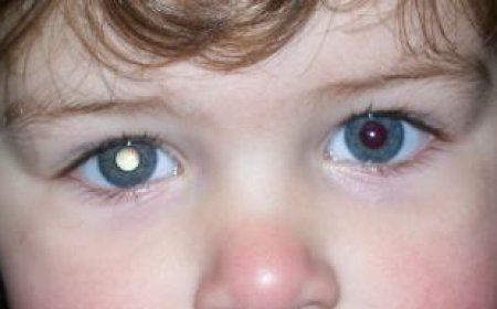 Retinoblastoma