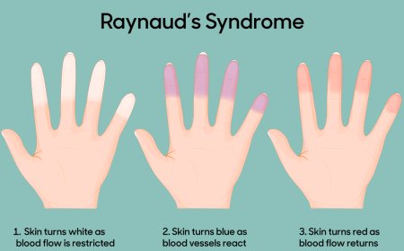 Raynaud's Disease