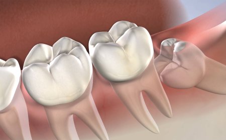 wisdom Tooth Removal