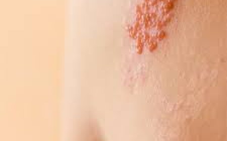 Shingles (Herpes Zoaster)