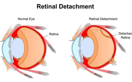 Retinal Detachment