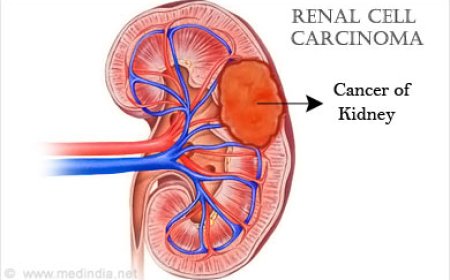 Renal Cell carcinoma ( RCC)