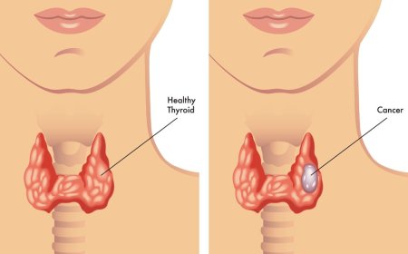 Thyroid Cancer