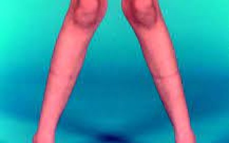 Vitamin-D deficiency rickets