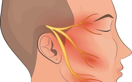 Trigeminal Neuralgia