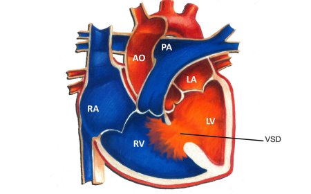 Ventricular septal defect (VSD)