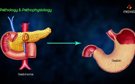 Zollinger-Ellison Syndrome