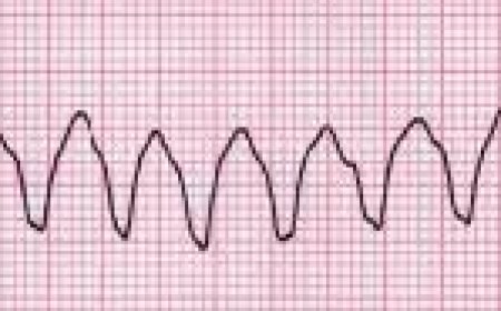 Ventricular tachycardia (VT)
