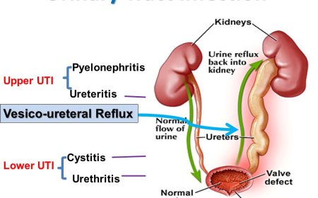 Urinary Tract Infections