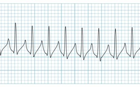 Tachycardia, Supraventricular