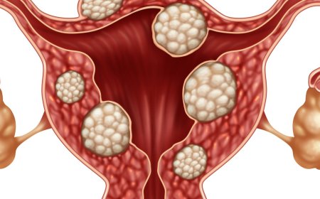 Uterine Fibroids