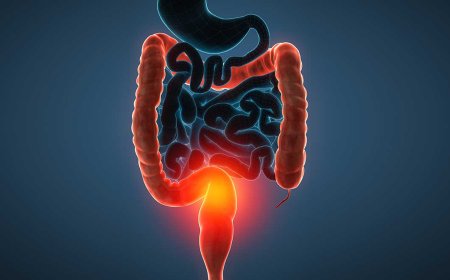Ulcerative Colitis