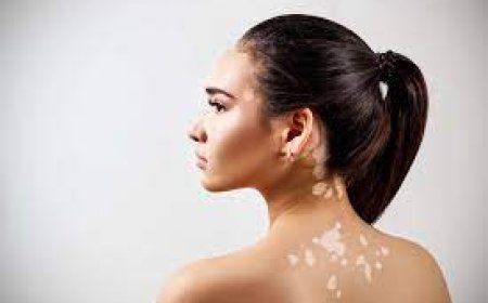 Vitiligo