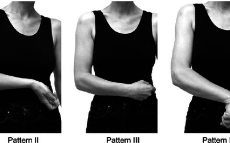 Upper Limb Spasticity (ULS)