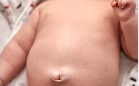 Umblical hernia in children
