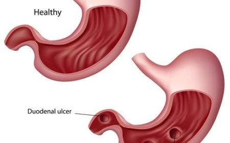 Ulcer - Peptic