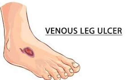 Venous skin ulcers
