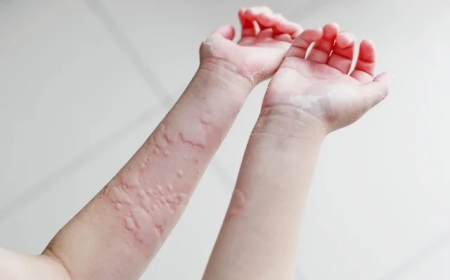 Urticaria