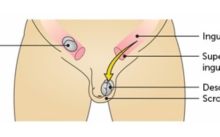 Undescended Testicle