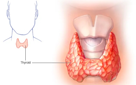 Underactive Thyroid (Hypothyroidism)